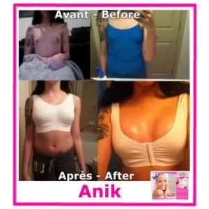 Breast enhancement before and after