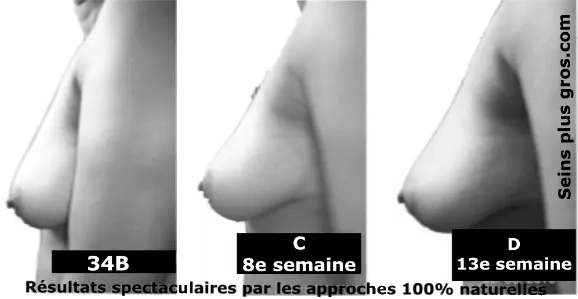 Breast enhancement before and after